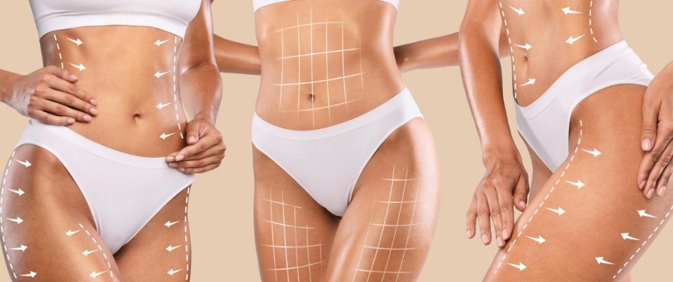 The Ultimate Guide to Liposuction