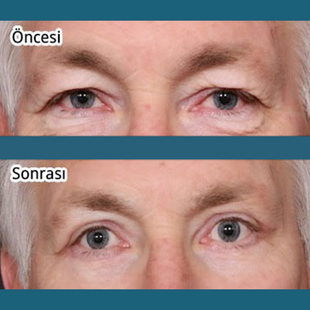 Upper & Lower Eyelid Surgery