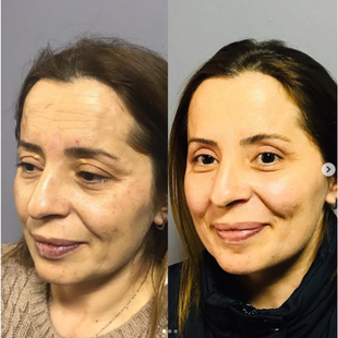 Upper & Lower Eyelid Surgery