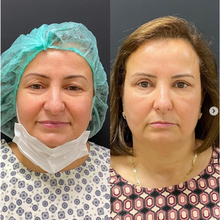 Upper & Lower Eyelid Surgery