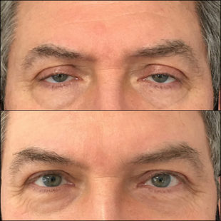 Upper Eyelid Surgery