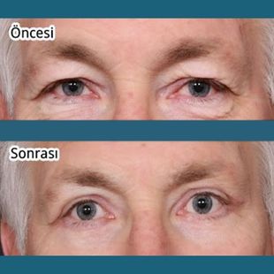 Upper Eyelid Surgery