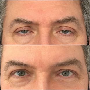 Upper Eyelid Surgery