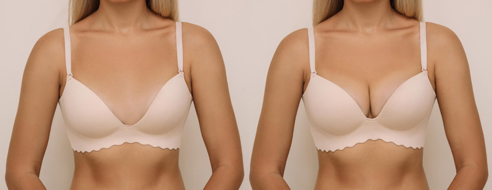 Sculpting Confidence: Understanding Breast Augmentation