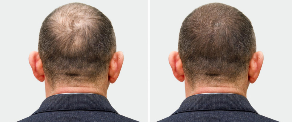 Hair Transplant Guide: All You Need to Know