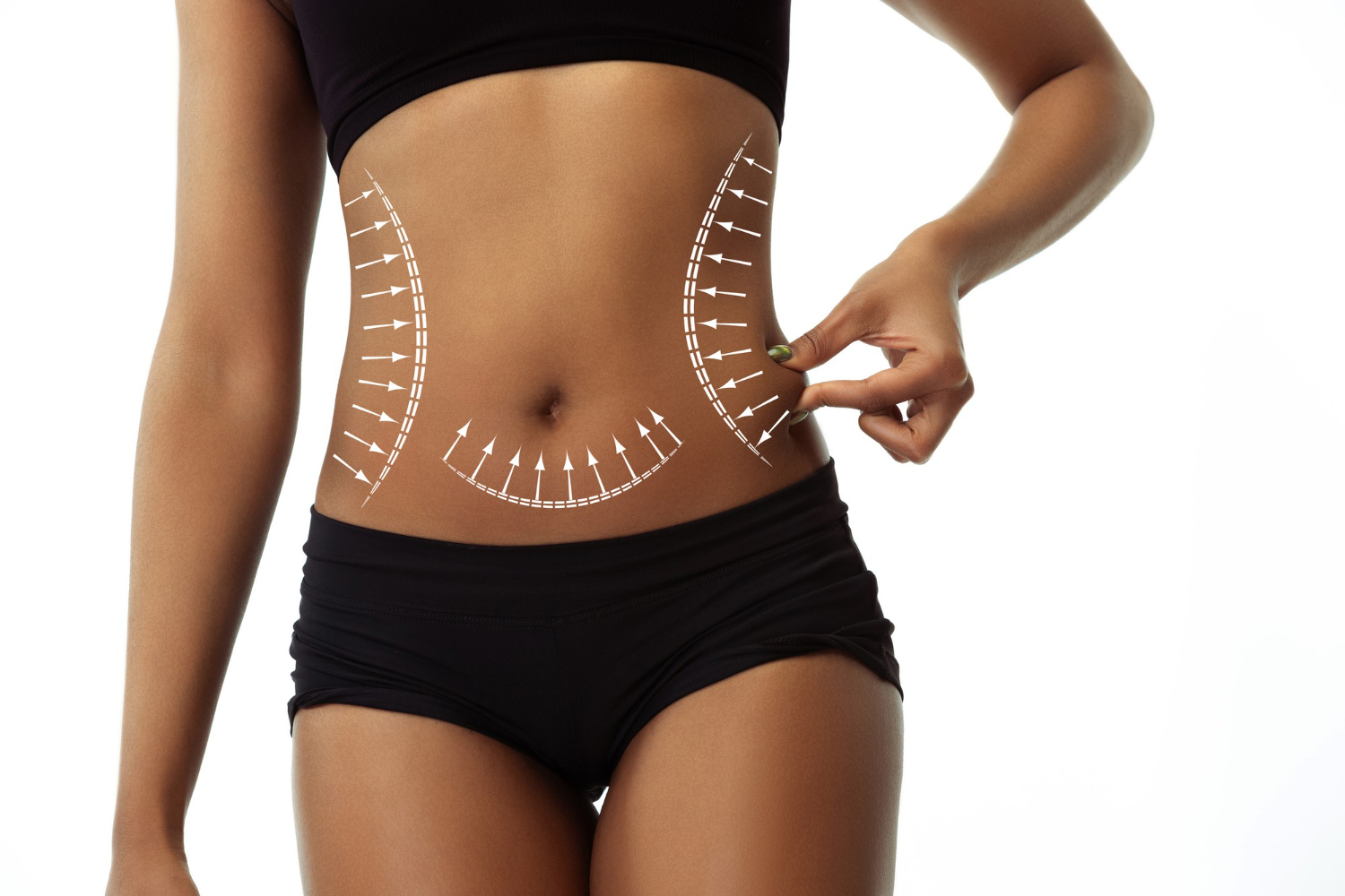 Abdominoplasty