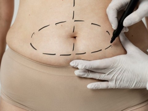 Liposuction 1 Bölge