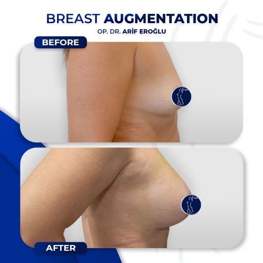 Breast Augmentation(Implant) + Lifting