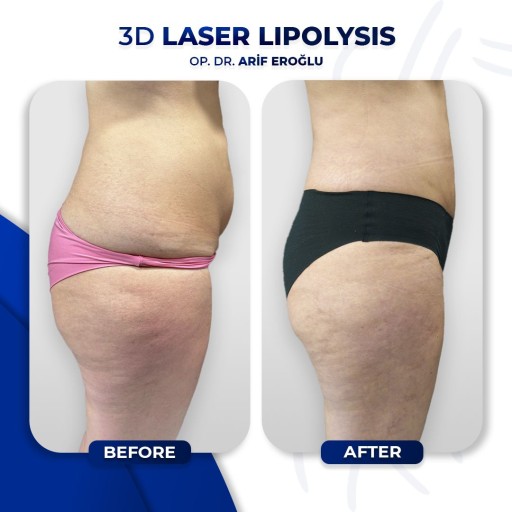 3D Laser Lipolysis