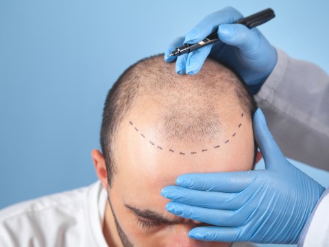 Hair and Beard Transplant