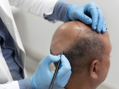 Hair Transplantation