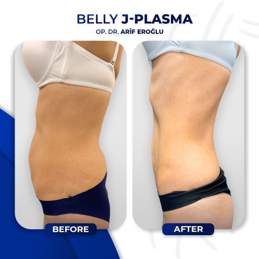 J-Plasma Renuvion (Skin Tightening) Surgery