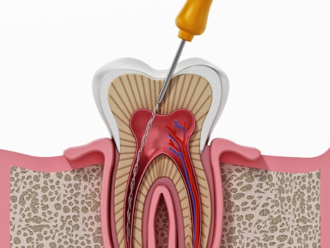 Root Canal Treatment