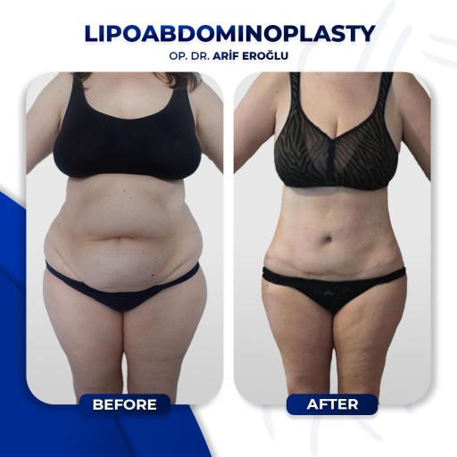 Abdominoplasty