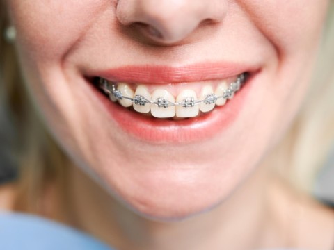 Orthodontic Treatment