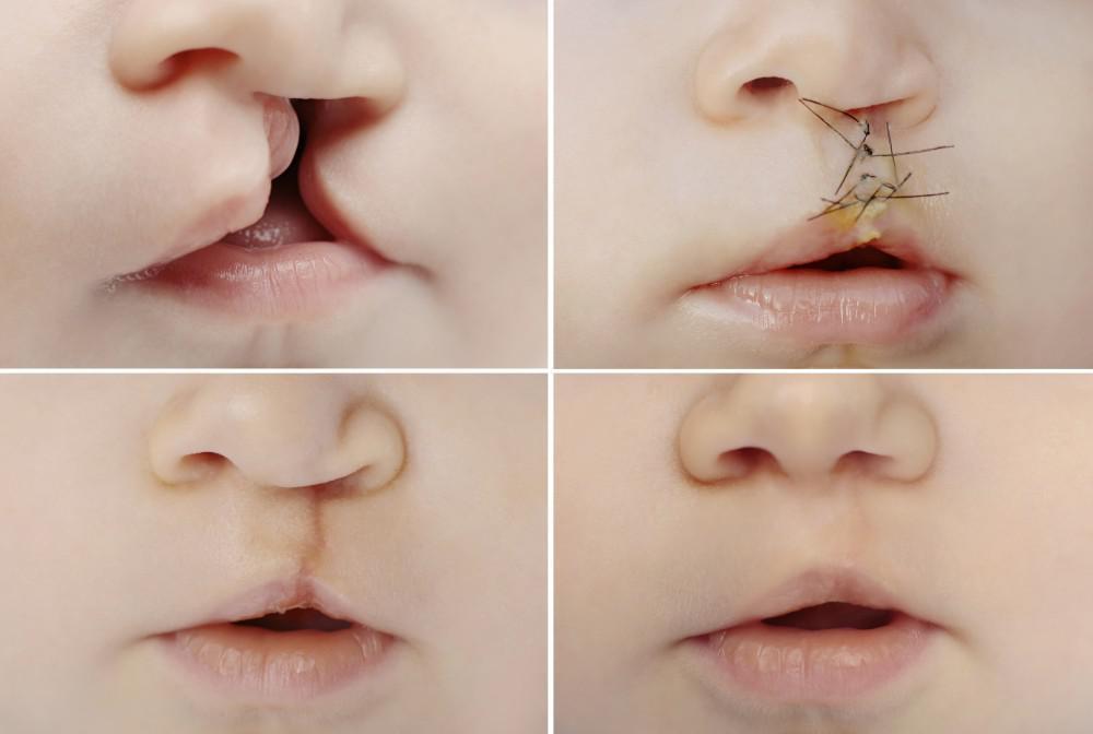 Cleft Lip and Palate Esthetics