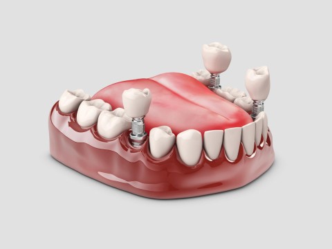 All On 4 Dental Implant