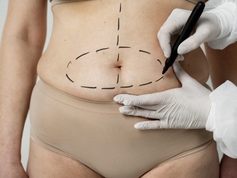 Abdominoplasty