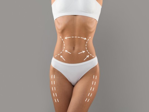 Liposuction (Tüm Vücut)