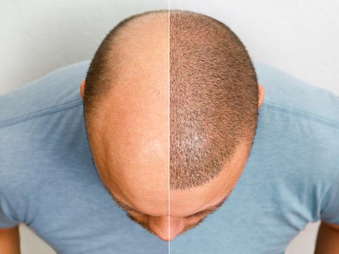 Hair Transplantation