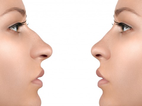 Rhinoplasty