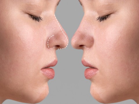 Nasal Tip-Plasty