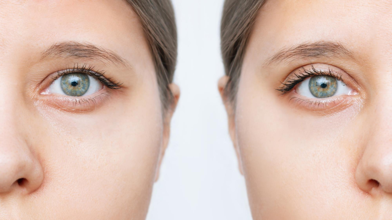 Upper Eyelid Blepharoplasty