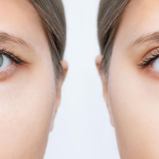 Upper Eyelid Blepharoplasty