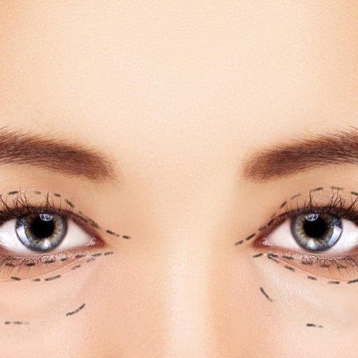 Upper and Lower Eyelid Blepharoplasty